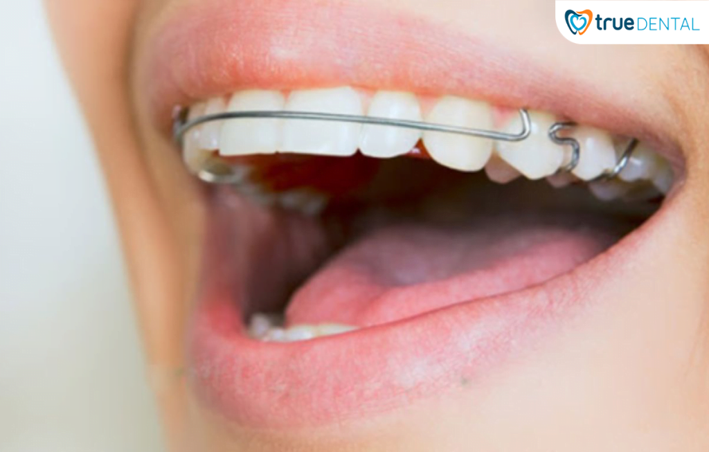 VÌ SAO PHẢI ĐEO HÀM DUY TRÌ SAU KHI CHỈNH NHA?