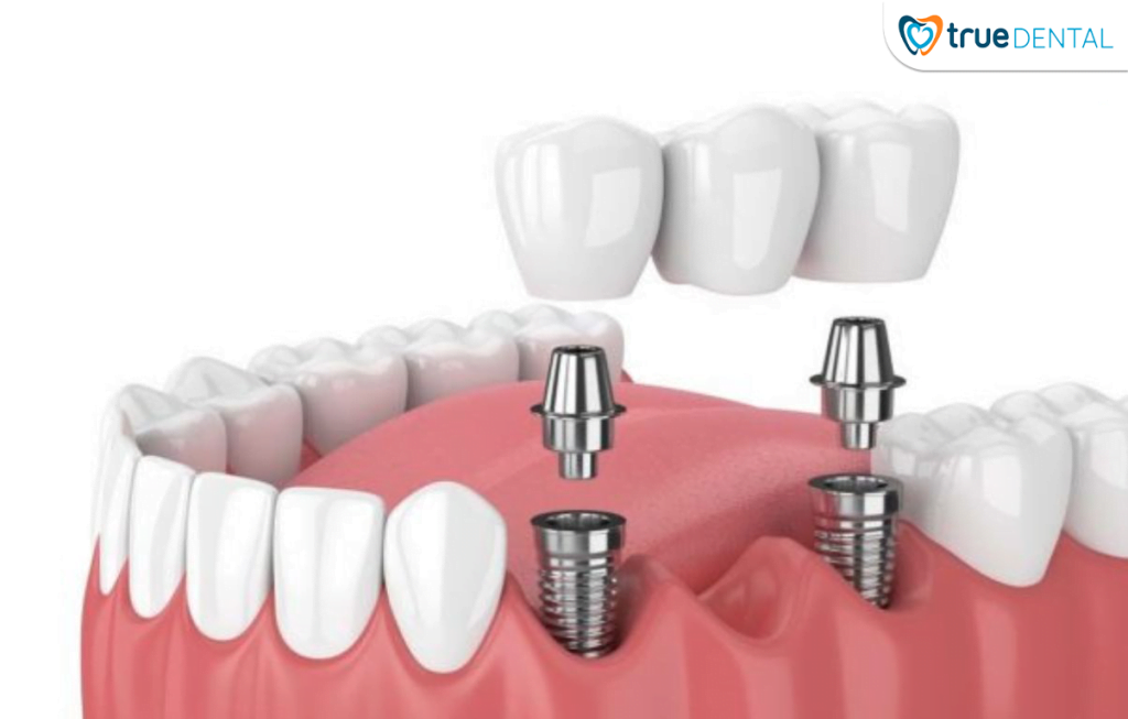 TRỒNG RĂNG IMPLANT - GIẢI PHÁP HOÀN HẢO PHỤC HÌNH RĂNG ĐÃ MẤT
