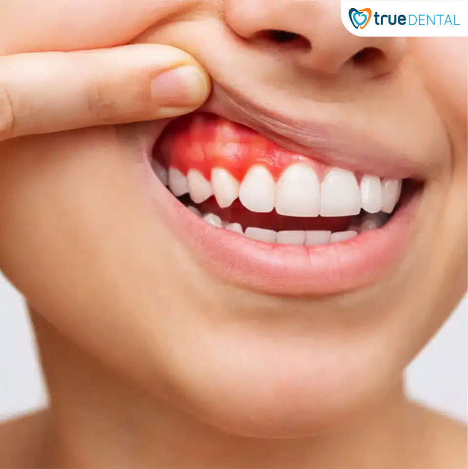 CÁC BỆNH LÝ RĂNG MIỆNG THƯỜNG GẶP: NGUYÊN NHÂN VÀ CÁCH ĐIỀU TRỊ?