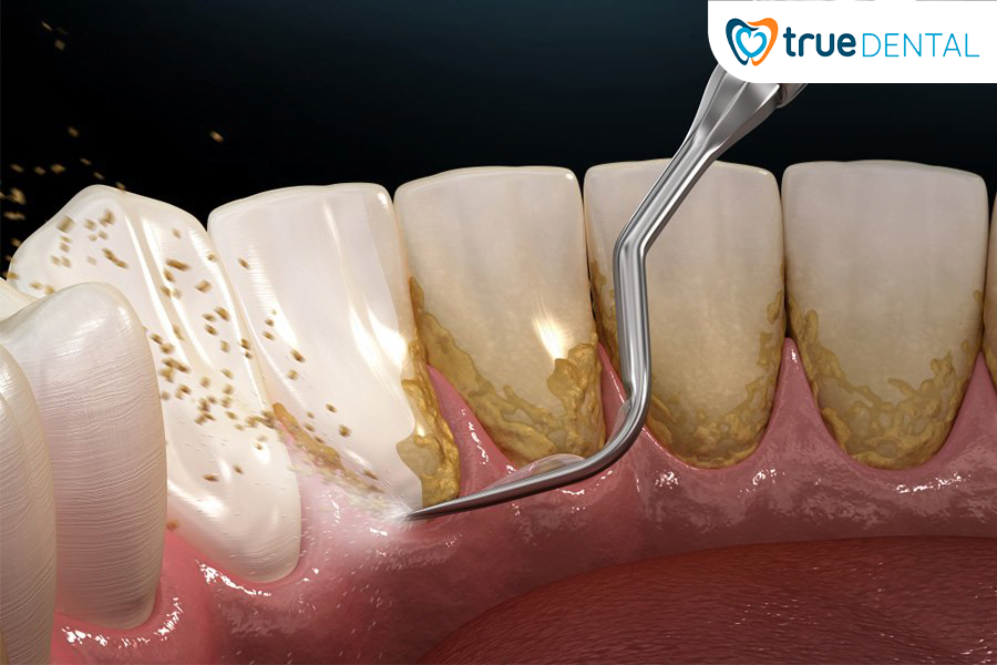 CẠO VÔI RĂNG ĐỊNH KỲ GIÚP NGĂN NGỪA BỆNH LÝ RĂNG MIỆNG HIỆU QUẢ