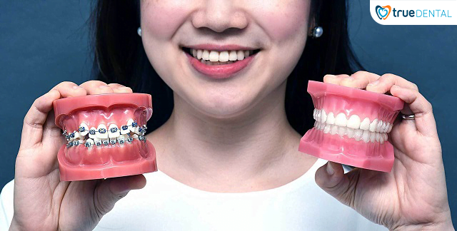 5 CHIA SẺ TỪ BÁC SĨ TRUE DENTAL VỀ NIỀNG RĂNG BẠN NÊN BIẾT