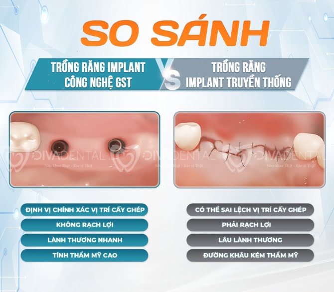So Sánh Cấy Ghép Implant GST