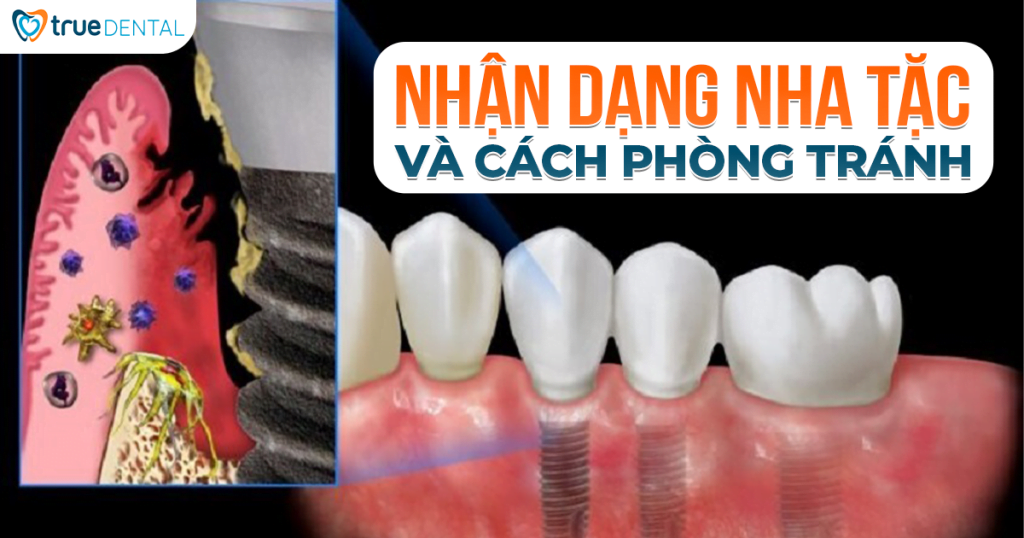 5 DẤU HIỆU NHẬN DẠNG NHA TẶC