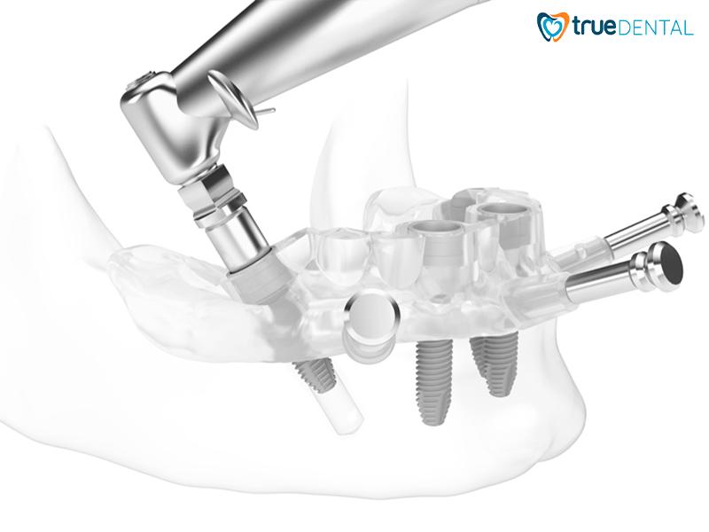 hinh 1 implant gst