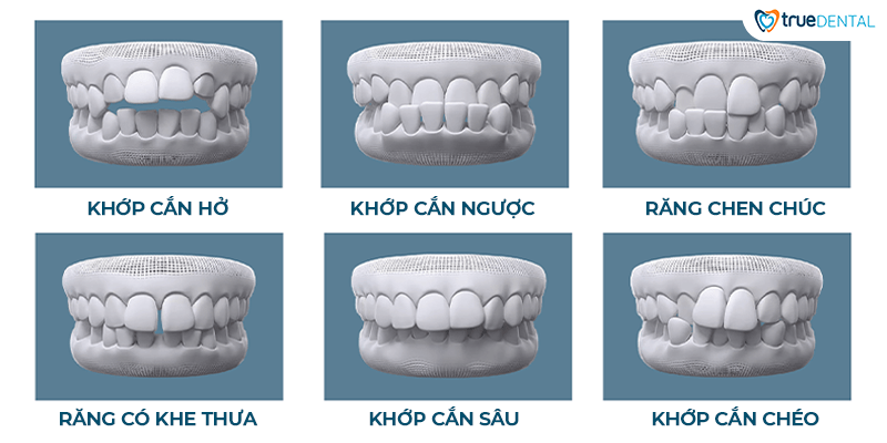 Sai lệch khớp cắn: Nguyên nhân, biểu hiện và phương pháp điều trị 31 hinh 1. cac truong hop lech khop can