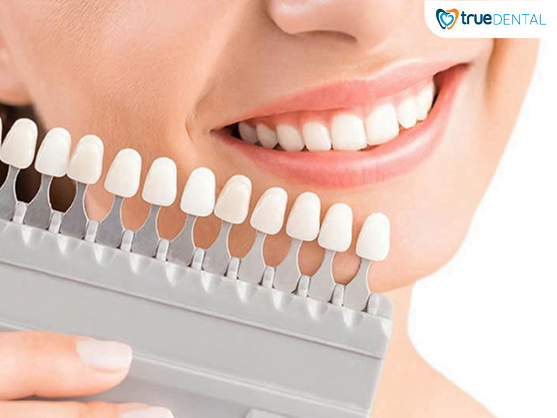 Thẩm mỹ răng sứ veneer Ultra Thin có phù hợp với bạn? 1 thẩm mỹ răng sứ Veneer Ultra Thin - xu hướng thẩm mỹ răng sứ hàng đầu
