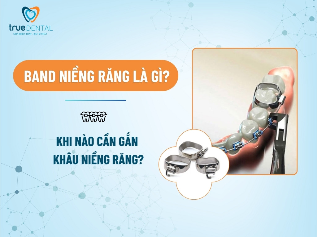 band niềng răng là gì? Khi nào cần gắn khâu niềng răng