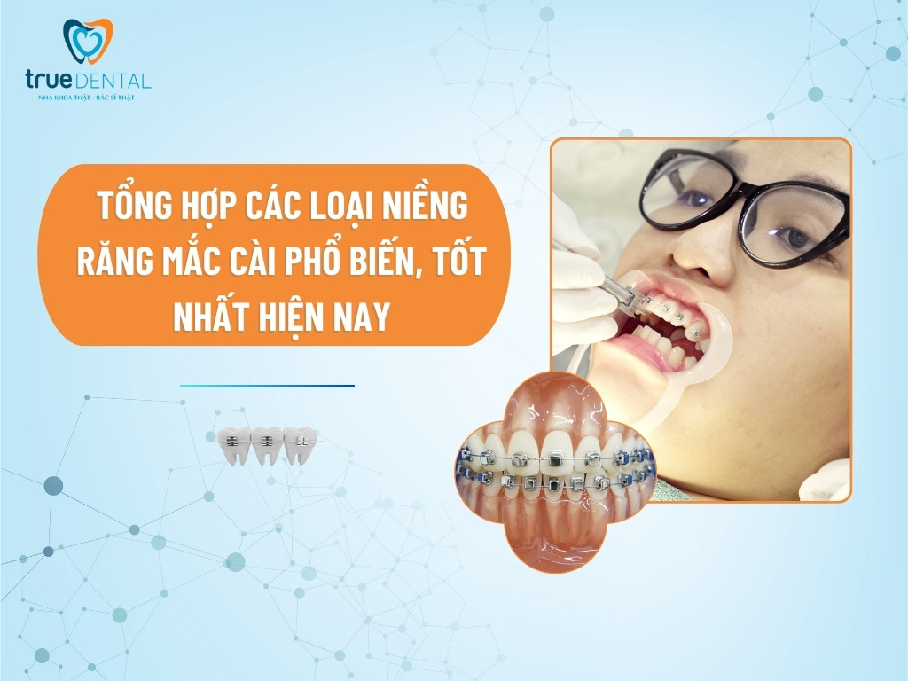 các loại mắc cài niềng răng