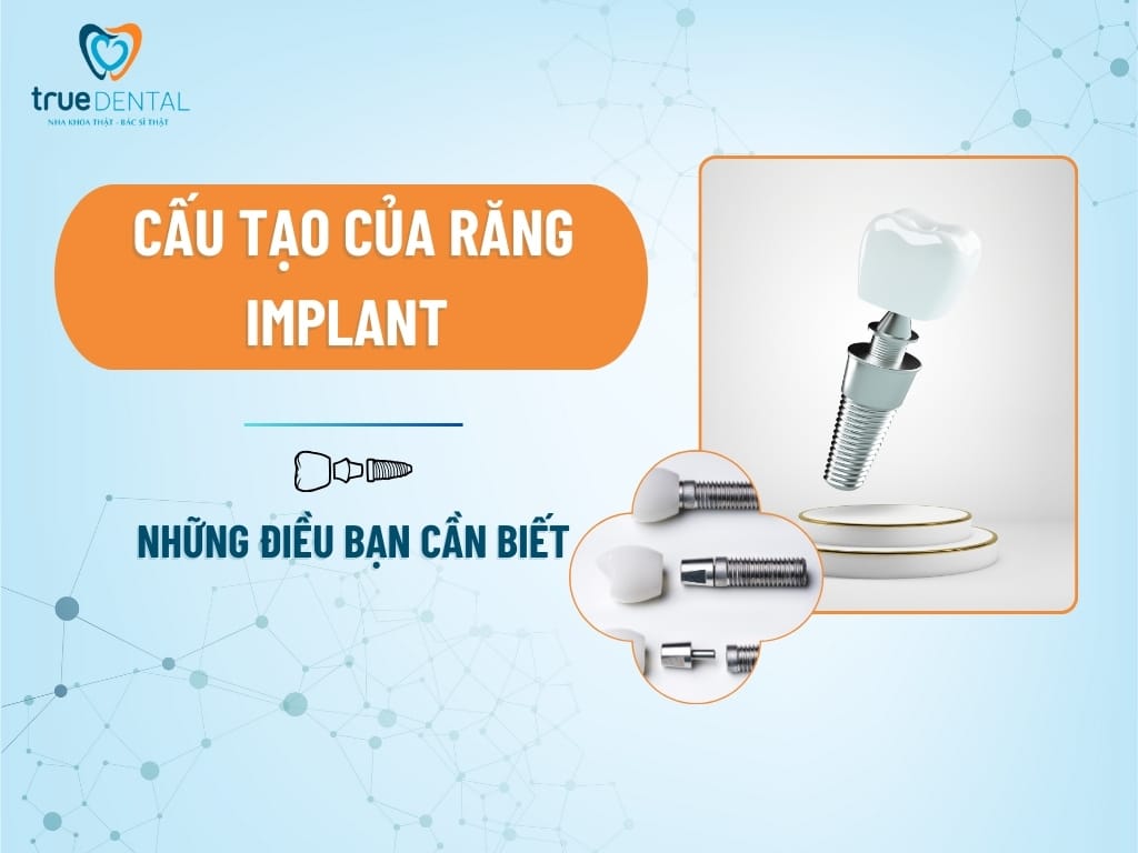 CẤU TẠO CỦA RĂNG IMPLANT VÀ NHỮNG ĐIỀU BẠN CẦN BIẾT