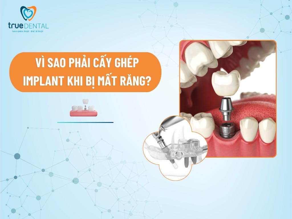 vì sao phải cấy ghép implant cho người bị mất răng