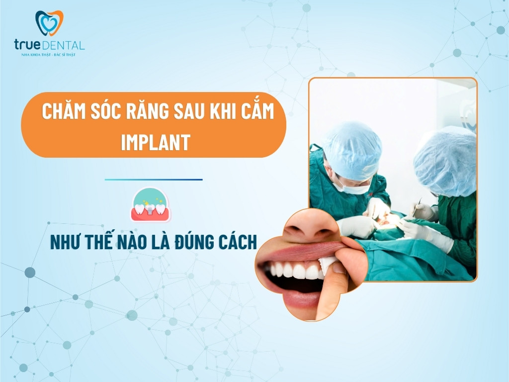 CHĂM SÓC RĂNG SAU KHI CẮM IMPLANT NHƯ THẾ NÀO LÀ ĐÚNG CÁCH