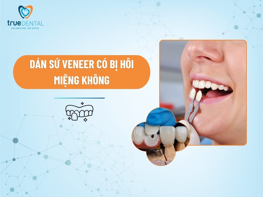 DÁN SỨ VENEER CÓ BỊ HÔI MIỆNG KHÔNG?