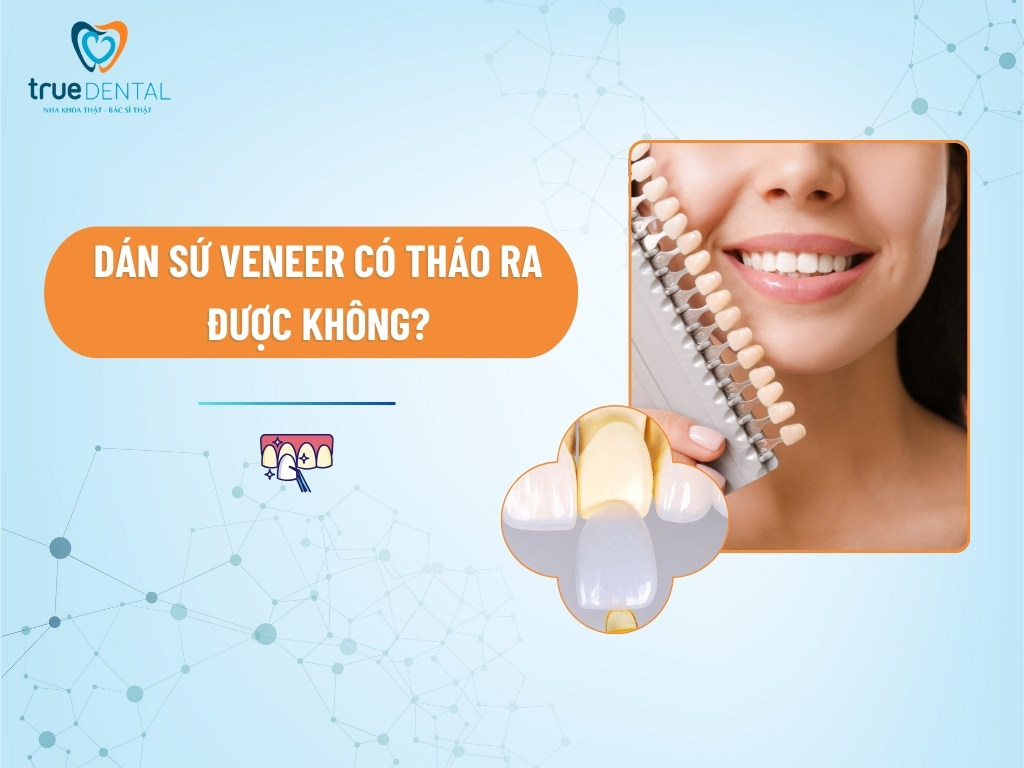 DÁN SỨ VENEER CÓ THÁO RA ĐƯỢC KHÔNG?