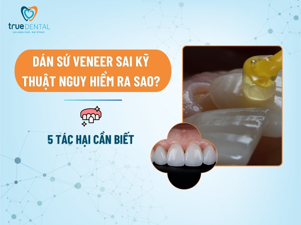 DÁN SỨ VENEER SAI KỸ THUẬT NGUY HIỂM RA SAO? 5 TÁC HẠI CẦN BIẾT