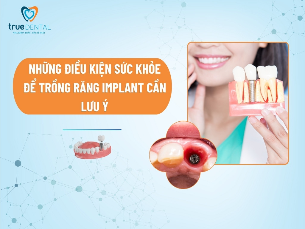 NHỮNG ĐIỀU KIỆN SỨC KHỎE ĐỂ TRỒNG RĂNG IMPLANT CẦN LƯU Ý