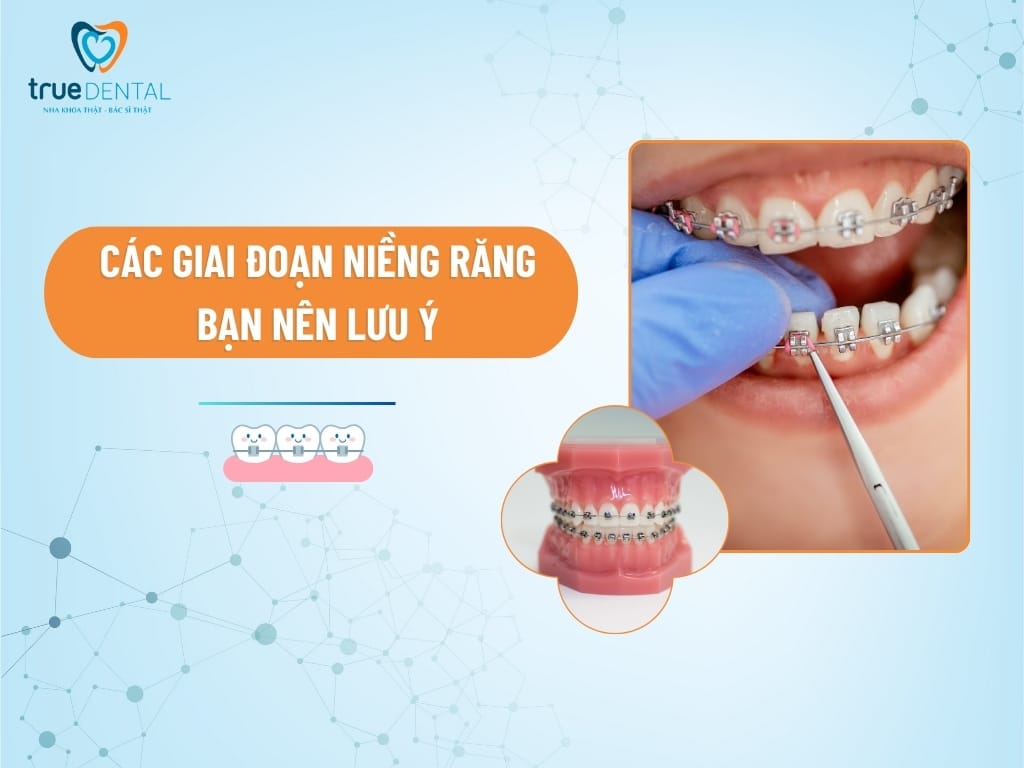 CÁC GIAI ĐOẠN NIỀNG RĂNG BẠN NÊN LƯU Ý