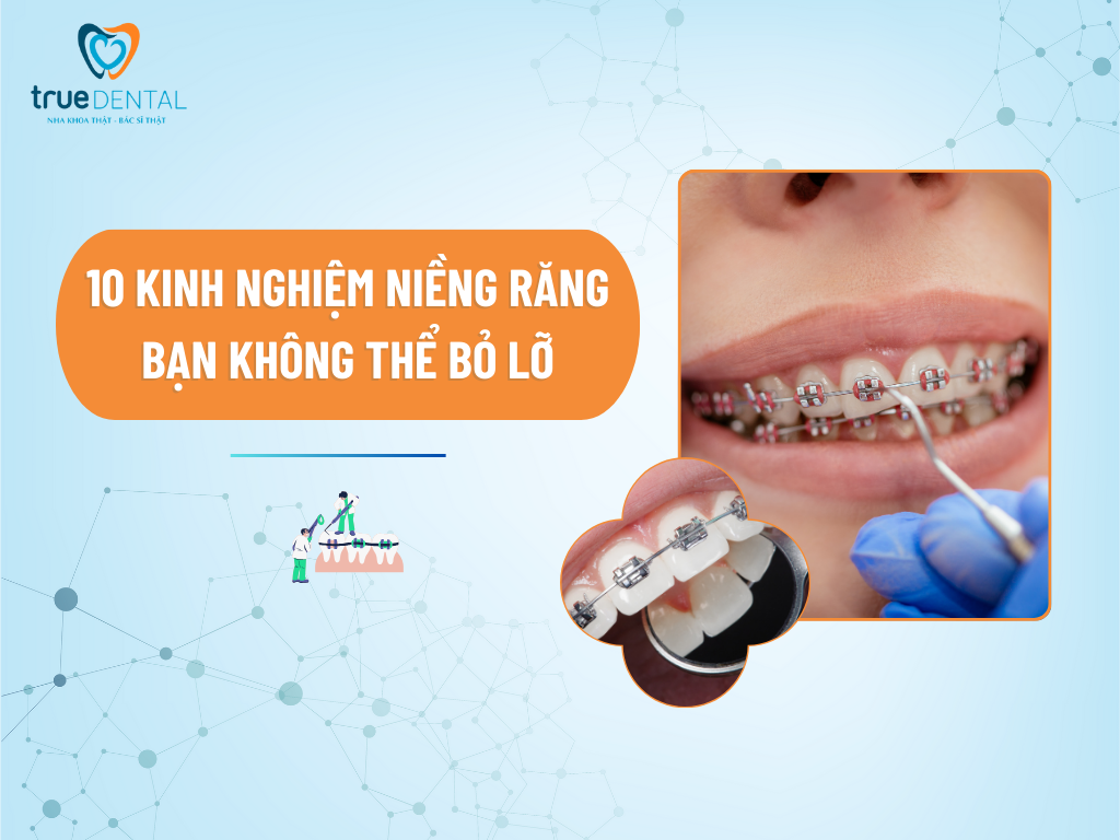 10 KINH NGHIỆM NIỀNG RĂNG BẠN KHÔNG THỂ BỎ LỠ