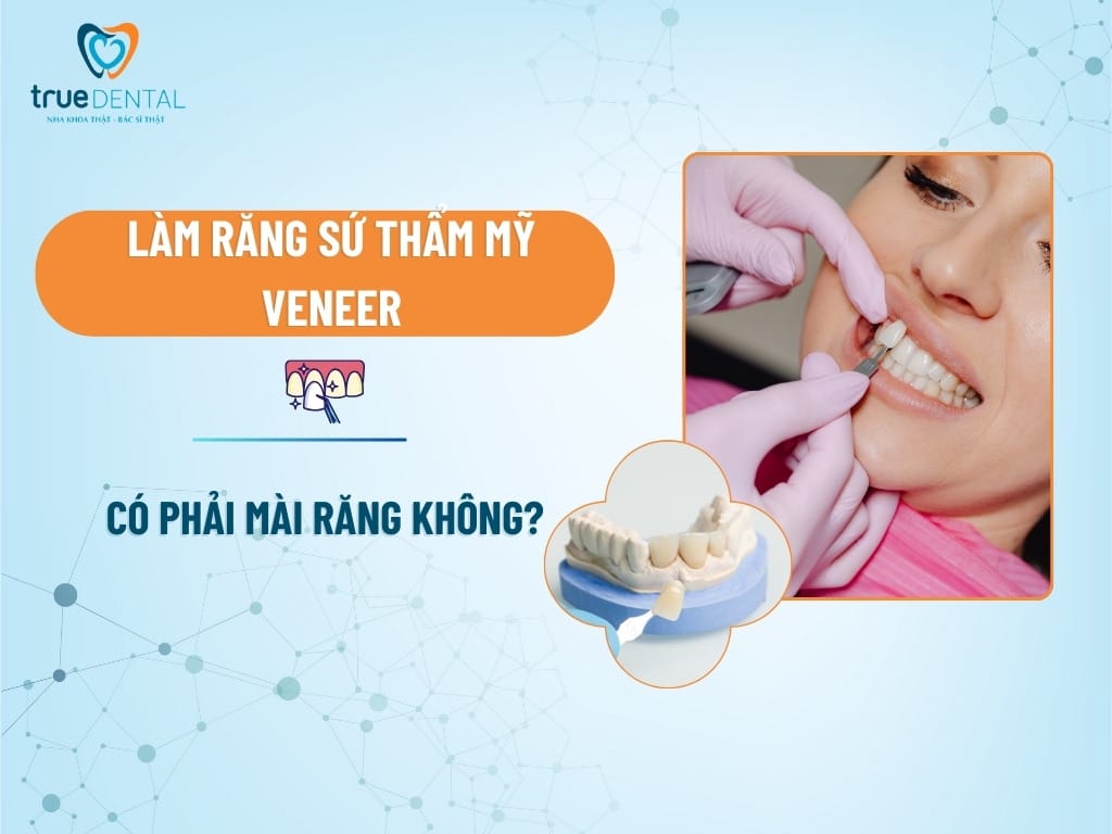 lam rang su tham my veneer co phai mai rang khong