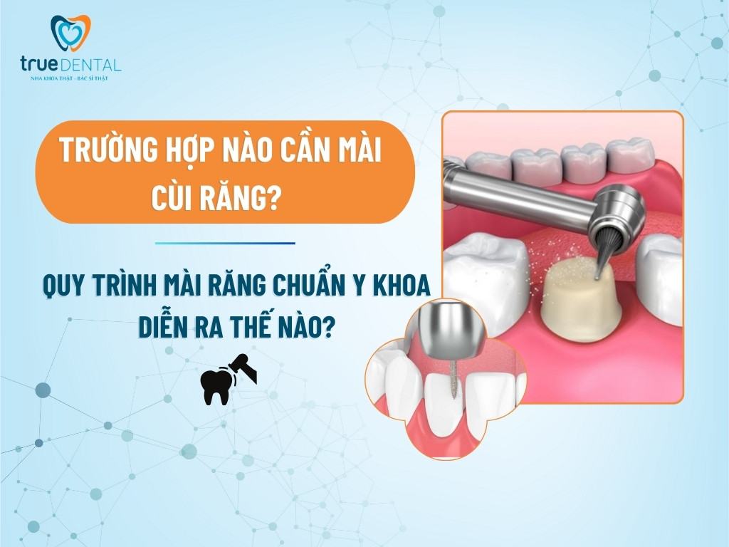 TRƯỜNG HỢP NÀO CẦN MÀI CÙI RĂNG? QUY TRÌNH MÀI RĂNG CHUẨN Y KHOA DIỄN RA THẾ NÀO?
