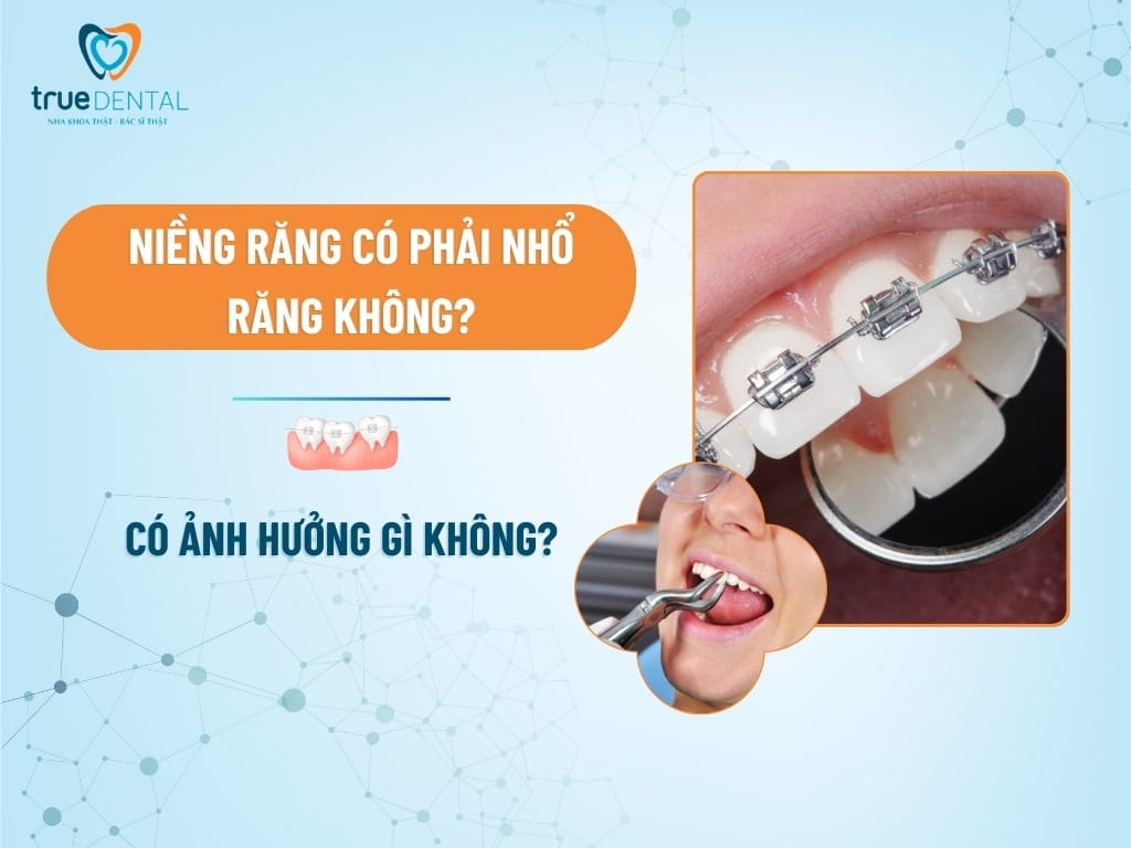 NIỀNG RĂNG CÓ PHẢI NHỔ RĂNG KHÔNG? CÓ ẢNH HƯỞNG GÌ KHÔNG?