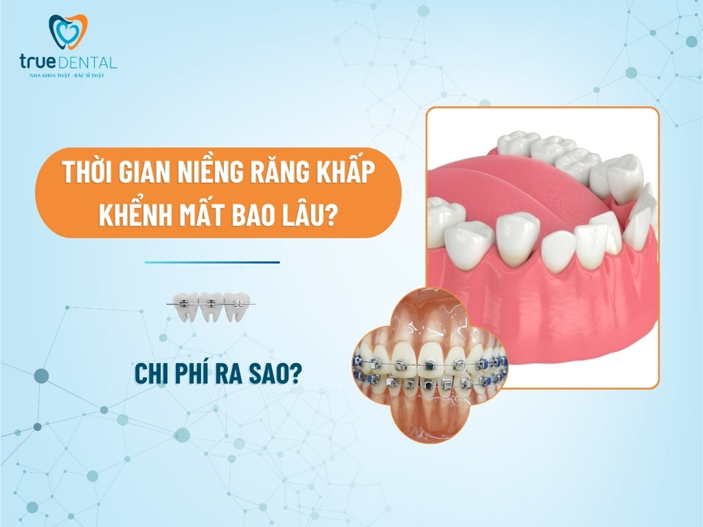 THỜI GIAN NIỀNG RĂNG KHẤP KHỂNH MẤT BAO LÂU? CHI PHÍ RA SAO?