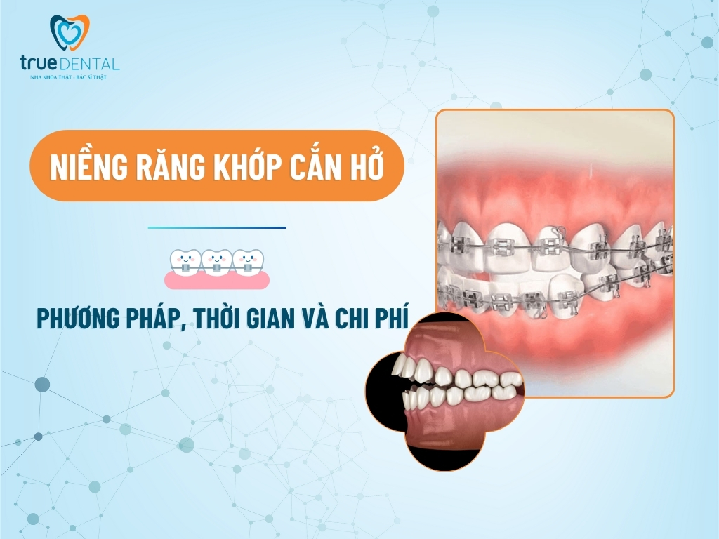 NIỀNG RĂNG KHỚP CẮN HỞ: PHƯƠNG PHÁP, THỜI GIAN VÀ CHI PHÍ
