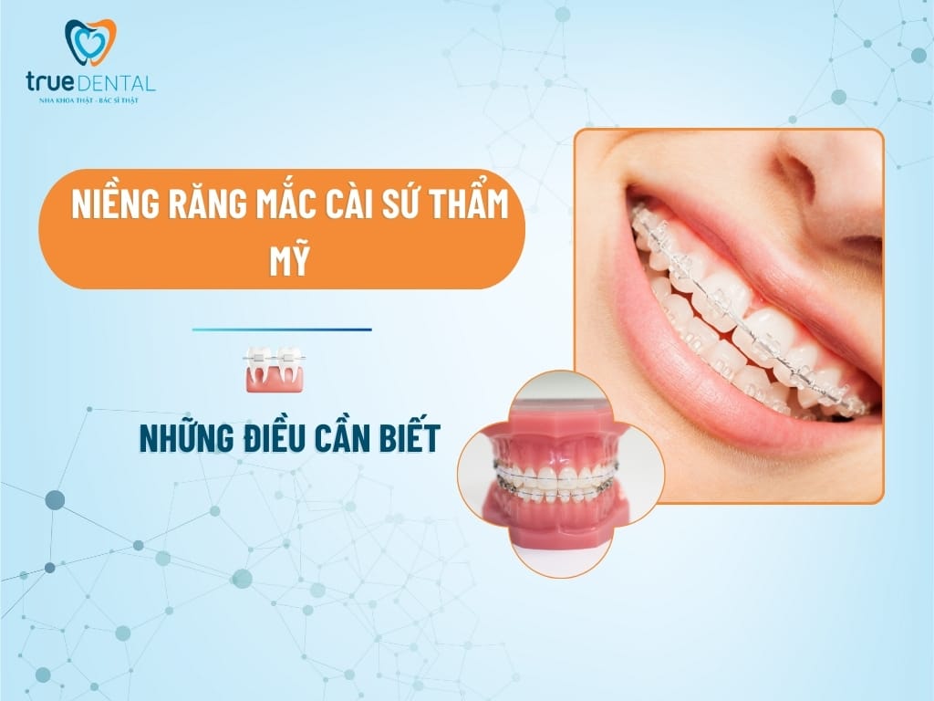 NIỀNG RĂNG MẮC CÀI SỨ THẨM MỸ VÀ NHỮNG ĐIỀU CẦN BIẾT
