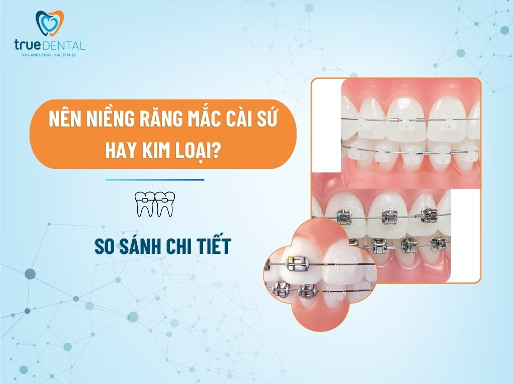 NÊN NIỀNG RĂNG MẮC CÀI SỨ HAY KIM LOẠI? SO SÁNH CHI TIẾT