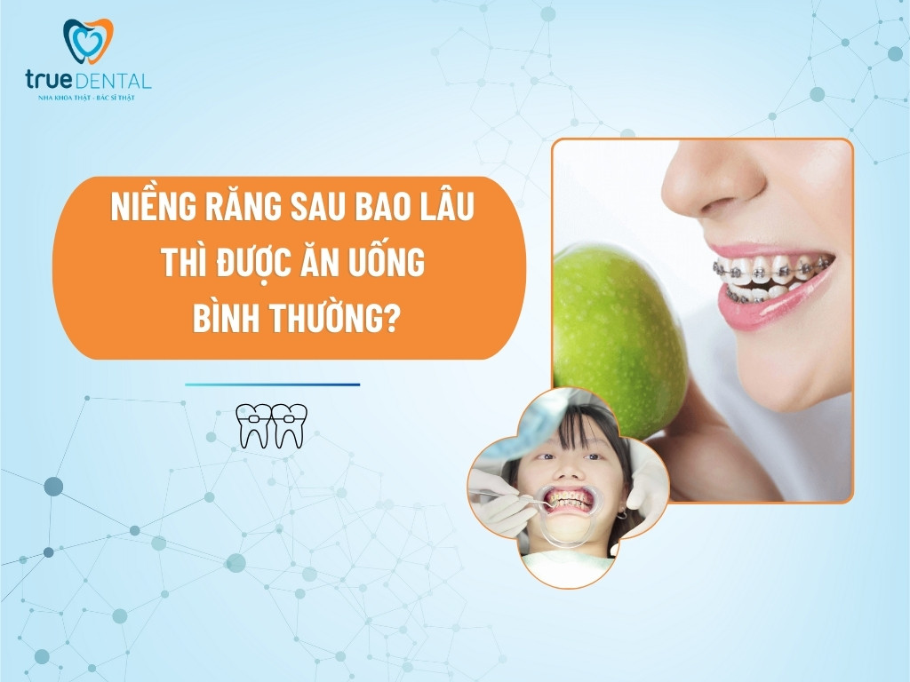 NIỀNG RĂNG SAU BAO LÂU THÌ ĐƯỢC ĂN UỐNG BÌNH THƯỜNG?