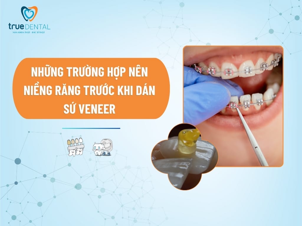 NHỮNG TRƯỜNG HỢP NÊN NIỀNG RĂNG TRƯỚC KHI DÁN SỨ VENEER