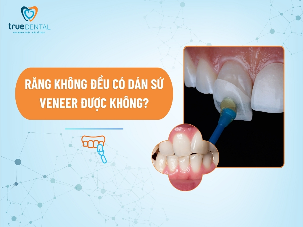[GIẢI ĐÁP] RĂNG KHÔNG ĐỀU CÓ DÁN SỨ VENEER ĐƯỢC KHÔNG?