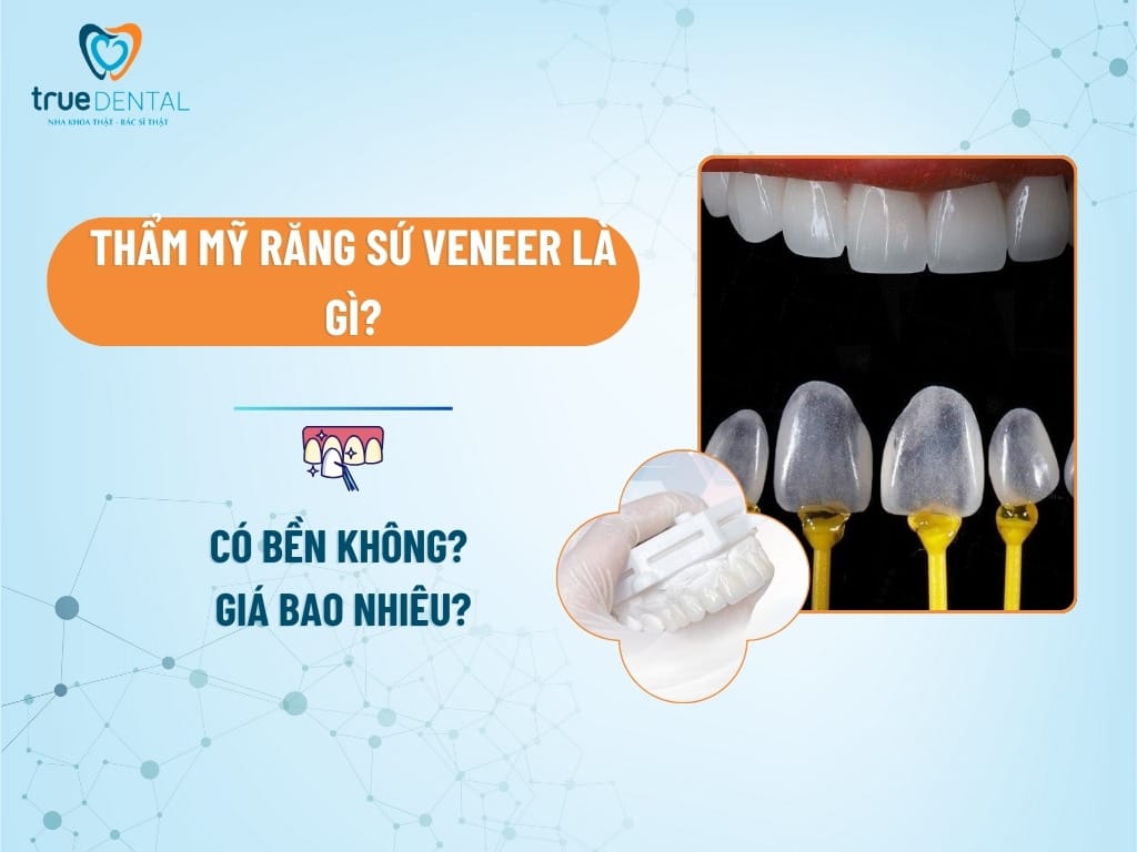 THẨM MỸ RĂNG SỨ VENEER LÀ GÌ? CÓ BỀN KHÔNG? GIÁ BAO NHIÊU?