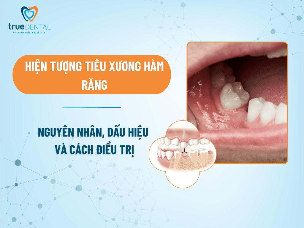 tieu xuong ham rang 1