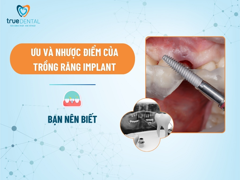 ƯU VÀ NHƯỢC ĐIỂM CỦA TRỒNG RĂNG IMPLANT BẠN NÊN BIẾT