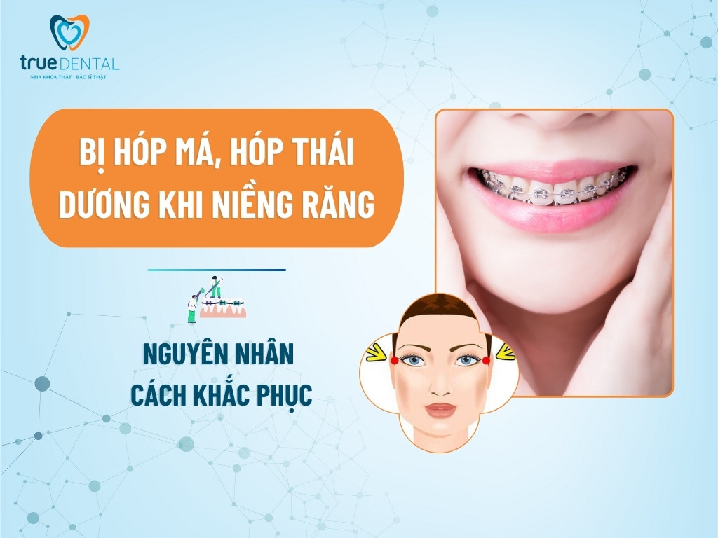 BỊ HÓP MÁ, HÓP THÁI DƯƠNG KHI NIỀNG RĂNG: NGUYÊN NHÂN VÀ CÁCH KHẮC PHỤC