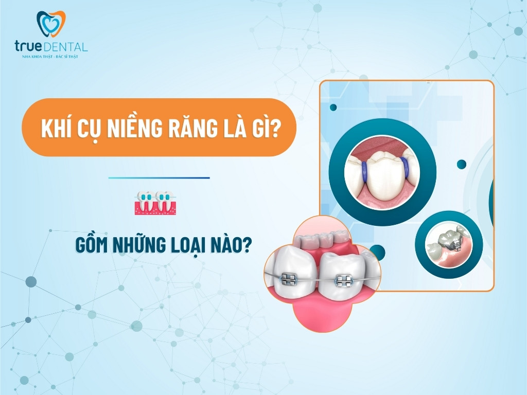 KHÍ CỤ NIỀNG RĂNG LÀ GÌ? GỒM NHỮNG LOẠI NÀO?