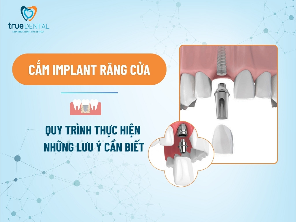 CẮM IMPLANT RĂNG CỬA: QUY TRÌNH THỰC HIỆN VÀ NHỮNG LƯU Ý CẦN BIẾT