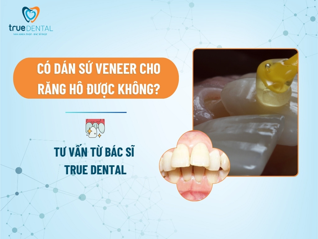 CÓ DÁN SỨ VENEER CHO RĂNG HÔ ĐƯỢC KHÔNG? TƯ VẤN TỪ BÁC SĨ
