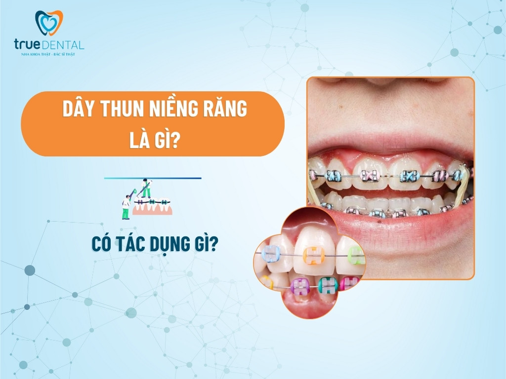 DÂY THUN NIỀNG RĂNG LÀ GÌ? CÓ TÁC DỤNG GÌ?
