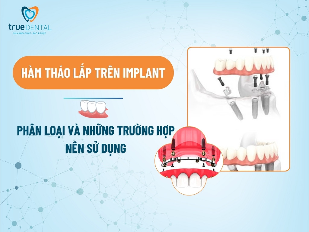 HÀM THÁO LẮP TRÊN IMPLANT: PHÂN LOẠI VÀ NHỮNG TRƯỜNG HỢP NÊN SỬ DỤNG