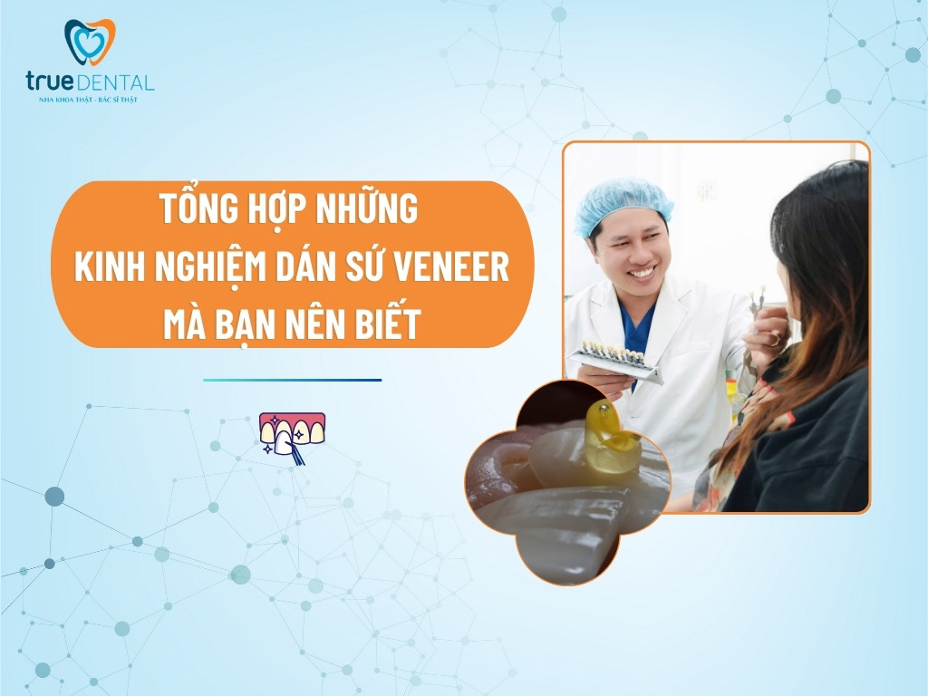 TỔNG HỢP NHỮNG KINH NGHIỆM DÁN SỨ VENEER MÀ BẠN NÊN BIẾT