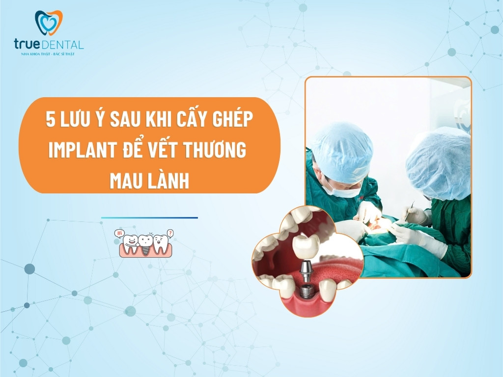 5 LƯU Ý SAU KHI CẤY GHÉP IMPLANT ĐỂ VẾT THƯƠNG MAU LÀNH
