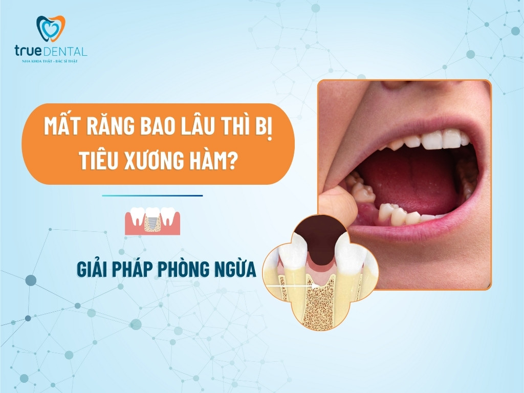 MẤT RĂNG BAO LÂU THÌ BỊ TIÊU XƯƠNG HÀM? GIẢI PHÁP PHÒNG NGỪA