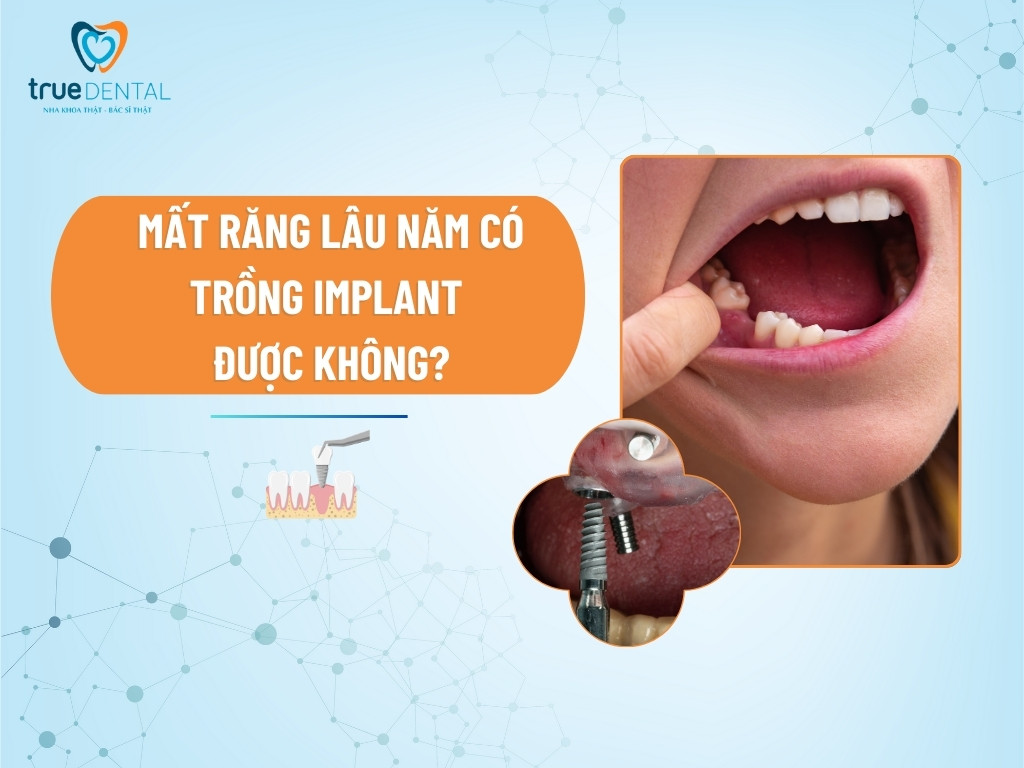 MẤT RĂNG LÂU NĂM CÓ TRỒNG IMPLANT ĐƯỢC KHÔNG?