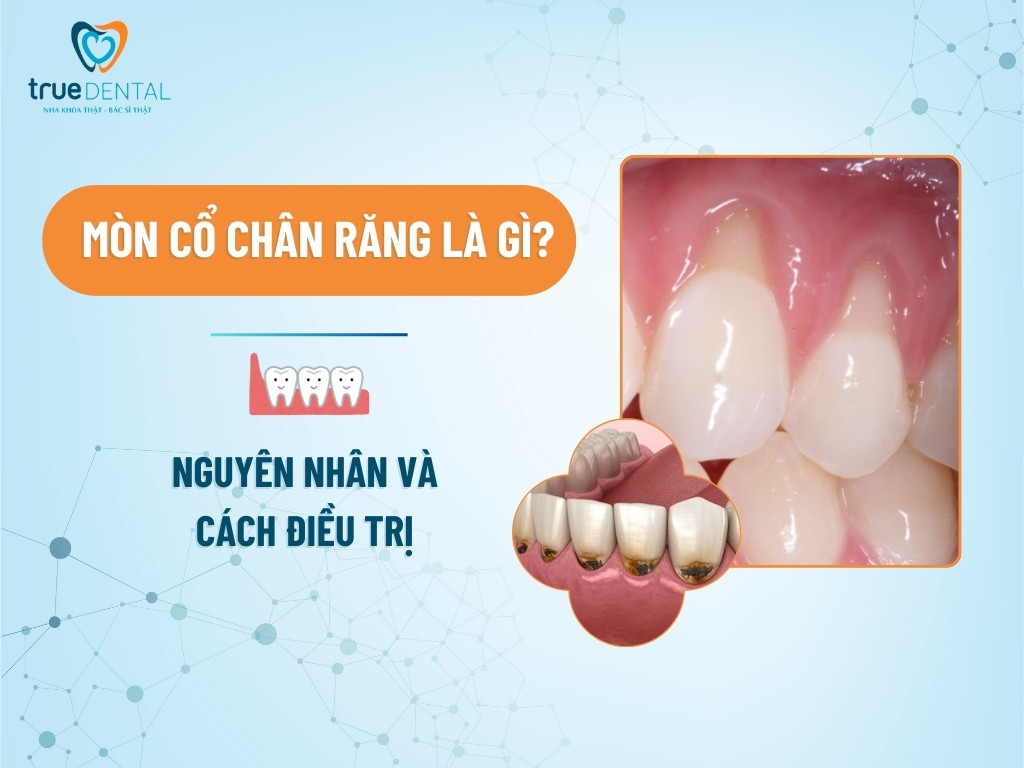 Mòn cổ chân răng là gì? Nguyên nhân và cách điều trị 2 MÒN CỔ CHÂN RĂNG LÀ GÌ? NGUYÊN NHÂN VÀ CÁCH ĐIỀU TRỊ