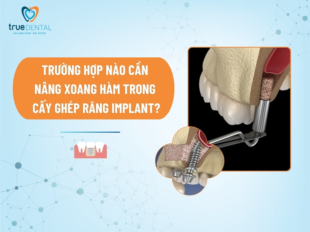 TRƯỜNG HỢP NÀO CẦN NÂNG XOANG HÀM TRONG CẤY GHÉP RĂNG IMPLANT?