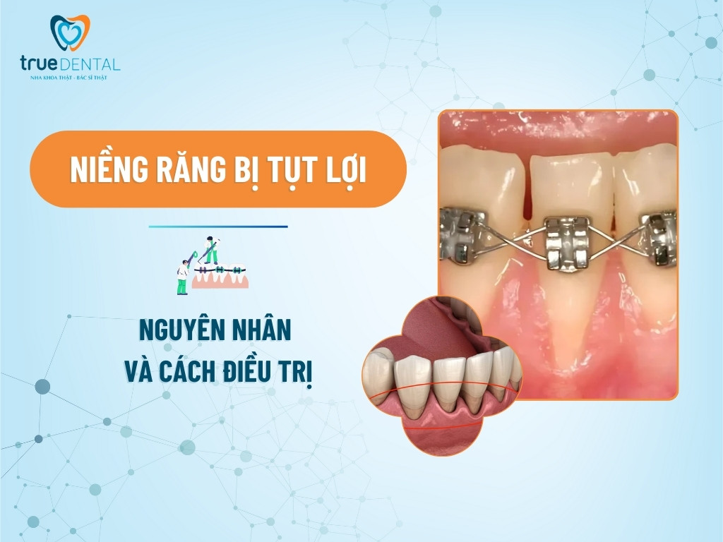 NIỀNG RĂNG BỊ TỤT LỢI: NGUYÊN NHÂN VÀ CÁCH ĐIỀU TRỊ