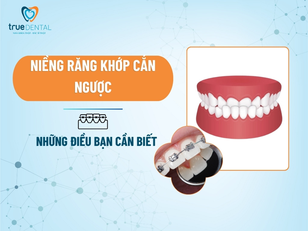 NIỀNG RĂNG KHỚP CẮN NGƯỢC VÀ NHỮNG ĐIỀU BẠN CẦN BIẾT