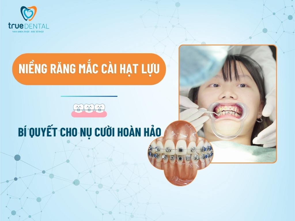NIỀNG RĂNG MẮC CÀI HẠT LỰU: BÍ QUYẾT CHO NỤ CƯỜI HOÀN HẢO