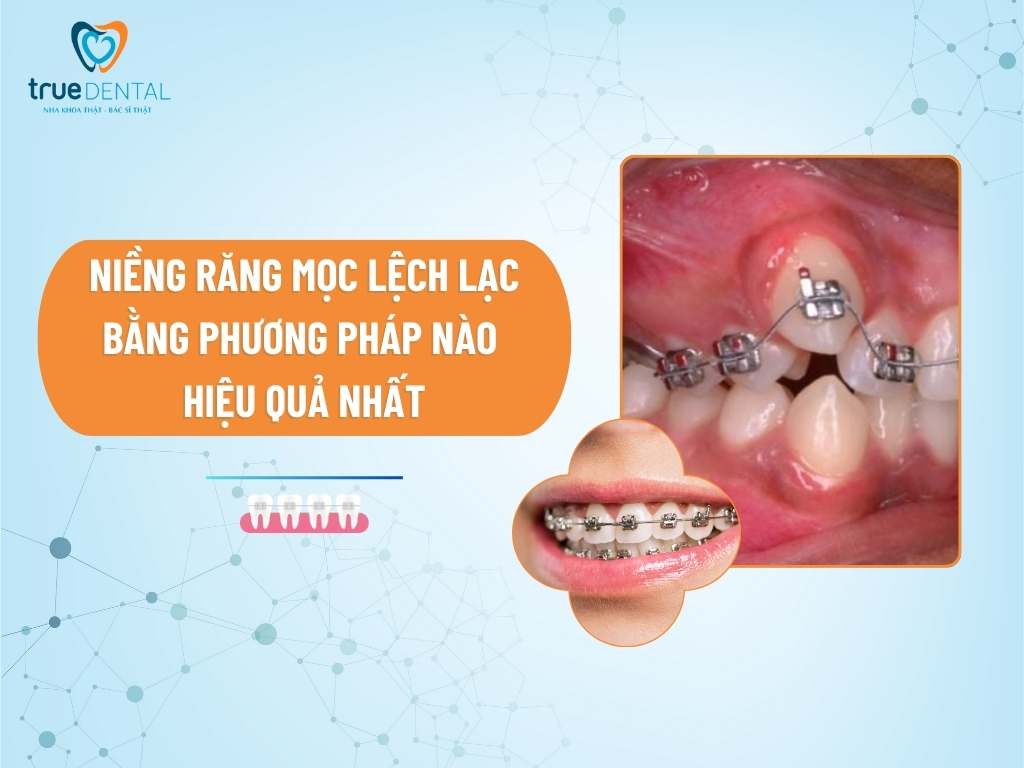 NIỀNG RĂNG MỌC LỆCH LẠC BẰNG PHƯƠNG PHÁP NÀO HIỆU QUẢ NHẤT
